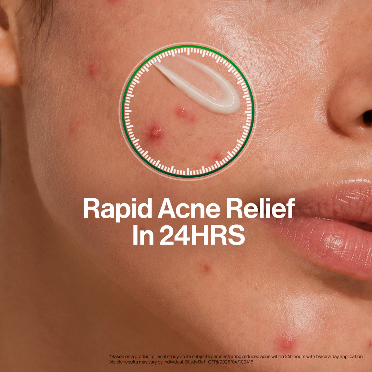 Spot Corrector for Acne | Starts acting in 24 hours