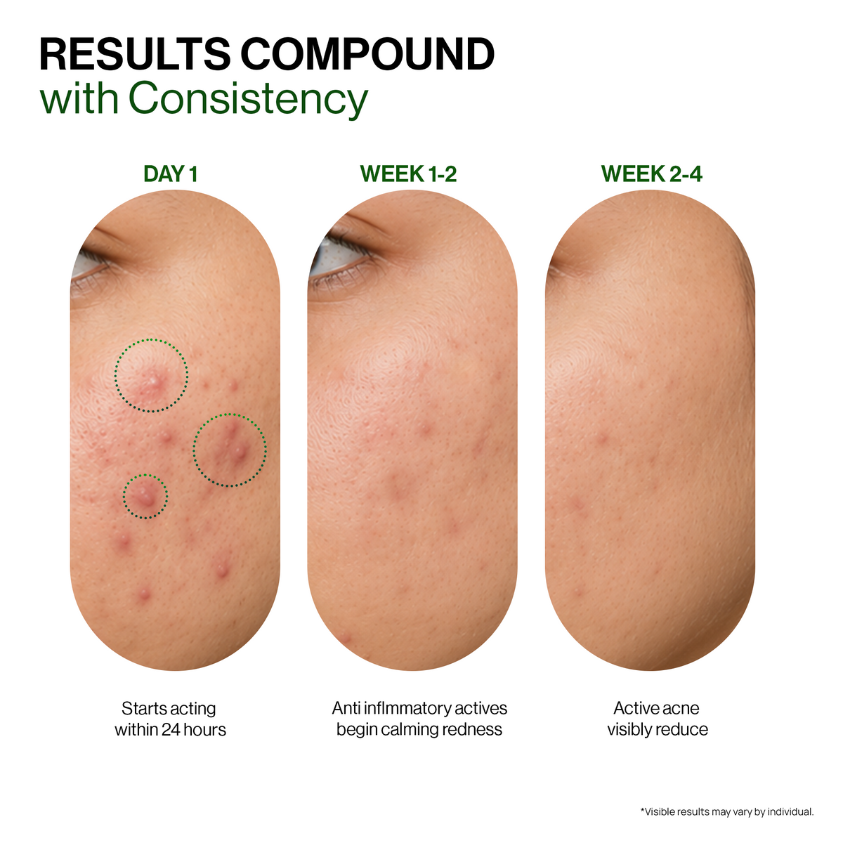 Spot Corrector for Acne | Starts acting in 24 hours