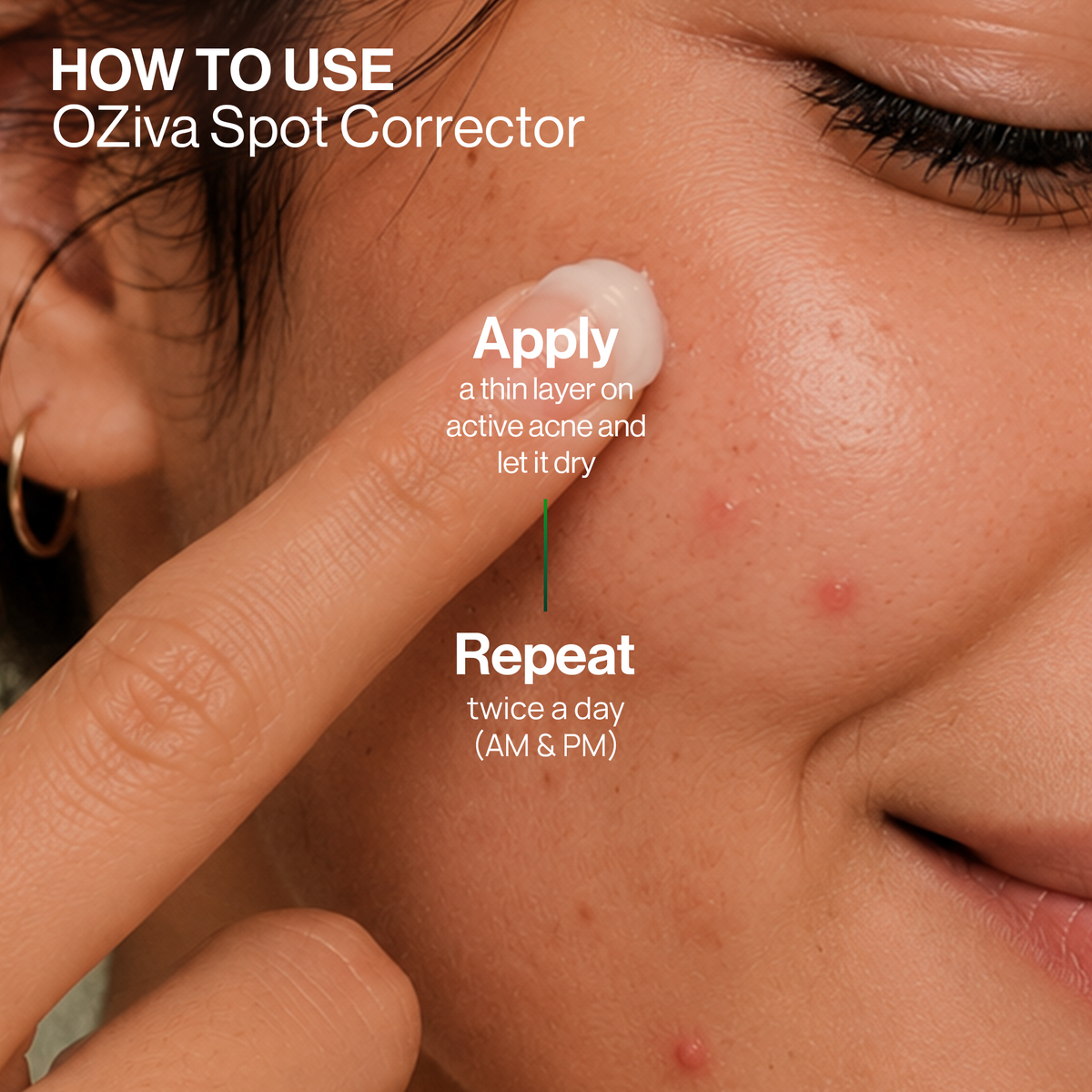 Spot Corrector for Acne | Starts acting in 24 hours